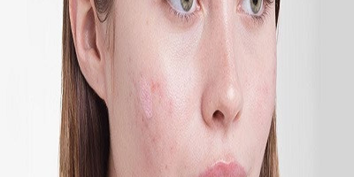 What should I expect during my first acne scar removal session?