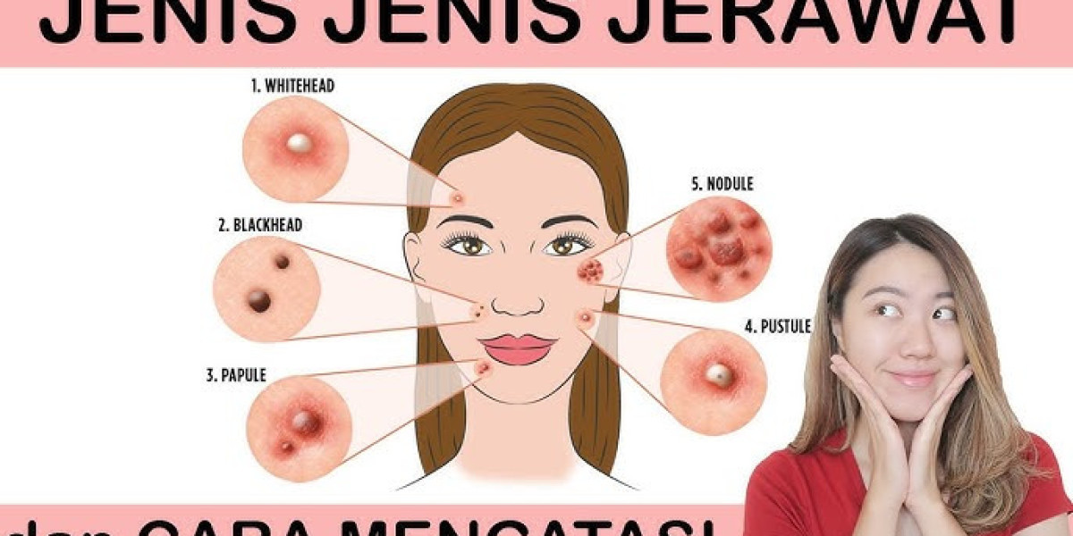 Faktor Penyebab Timbulnya Jerawat