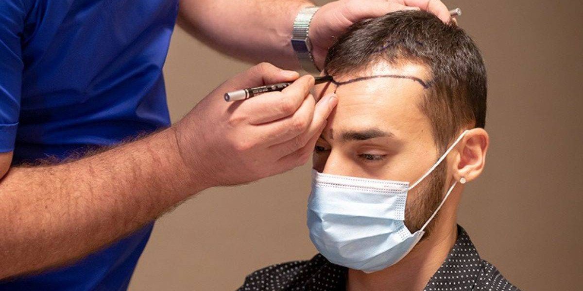 What to Expect After a Hair Transplant in Islamabad