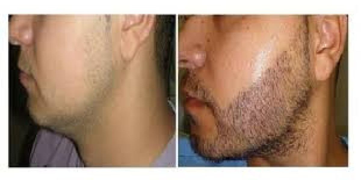 The Rising Trend of Facial Hair Transplants