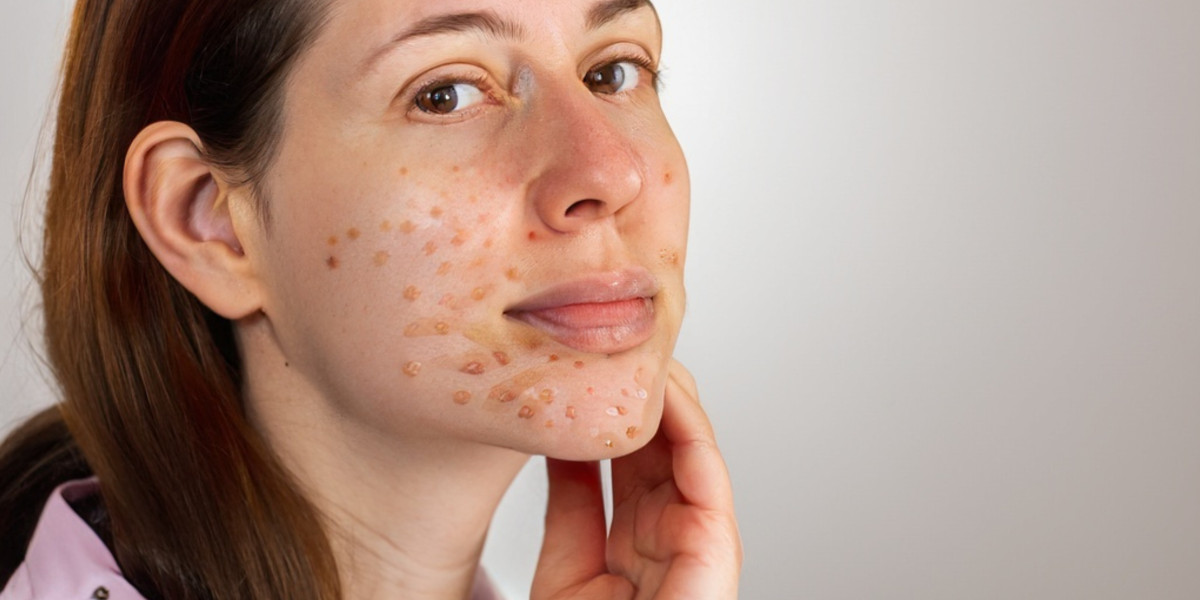 The Right Way To Care For Acne-Prone Skin
