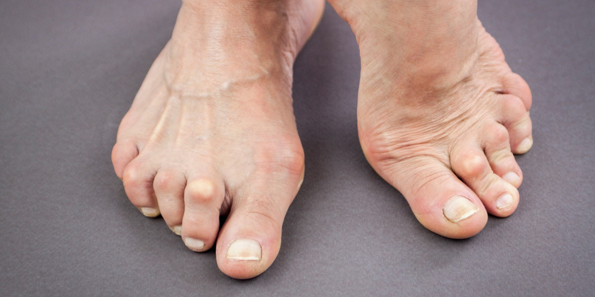Get Support for Foot Deformity Issues with Orthotics in Edinburgh