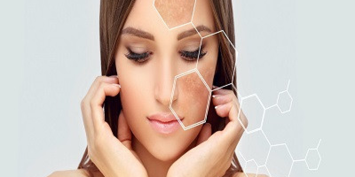 Combination Therapies for Severe Melasma in Islamabad