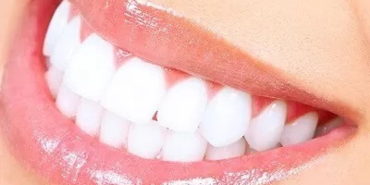 Why Choose Laser Teeth Whitening Over Traditional Whitening Methods?