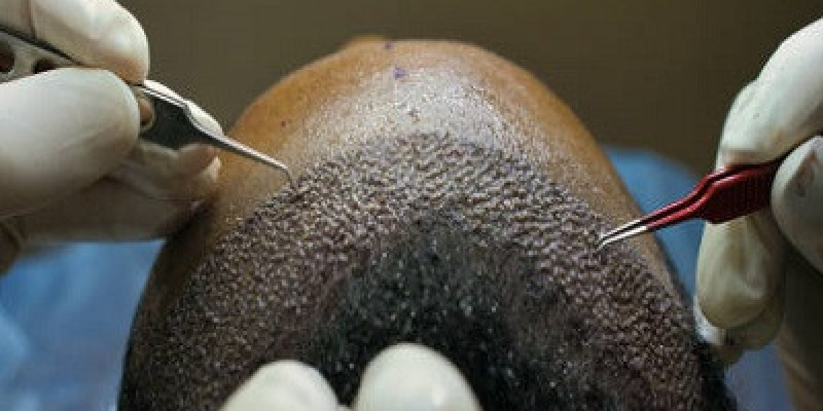 Can Hair Transplants Be Repeated for Better Results?