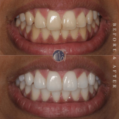Oral-B 3D White LUXE Whitening Strips Advanced Seal Profile Picture