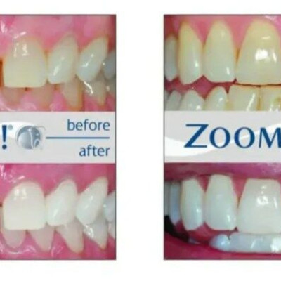 Philips Zoom Day White 6% Teeth Whitening Gel Profile Picture