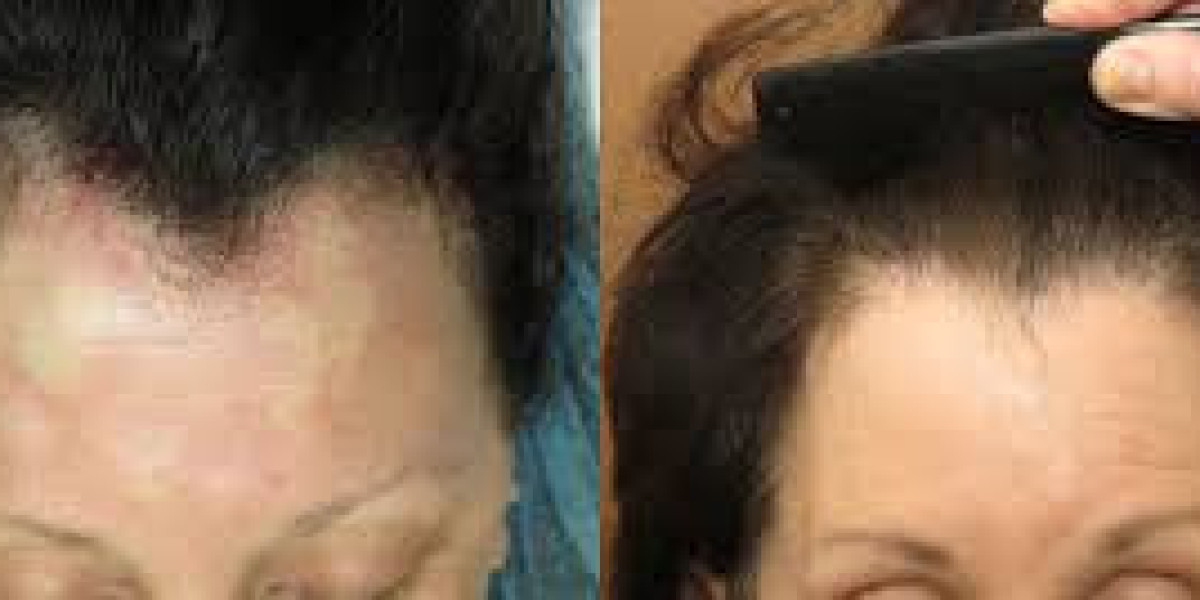 Natural Hairline Restoration for Ladies