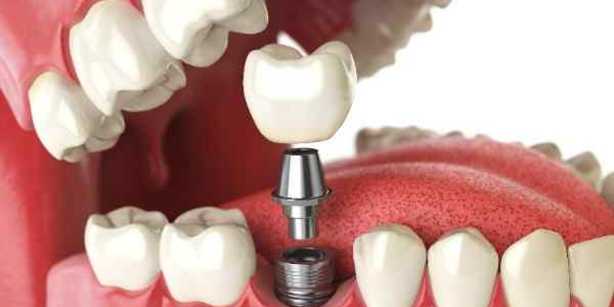 Natural Looking Implants Tailored Precise Lasting