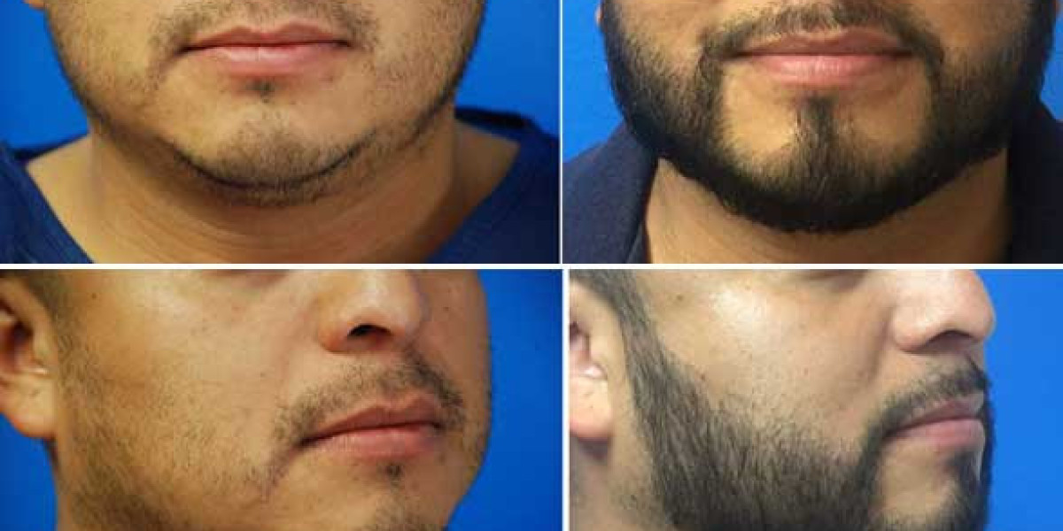 The Rise of Modern Beard Transplants