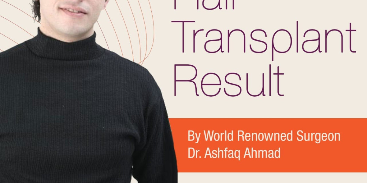 Hair Restoration in Islamabad Modern Solution for Hair Loss