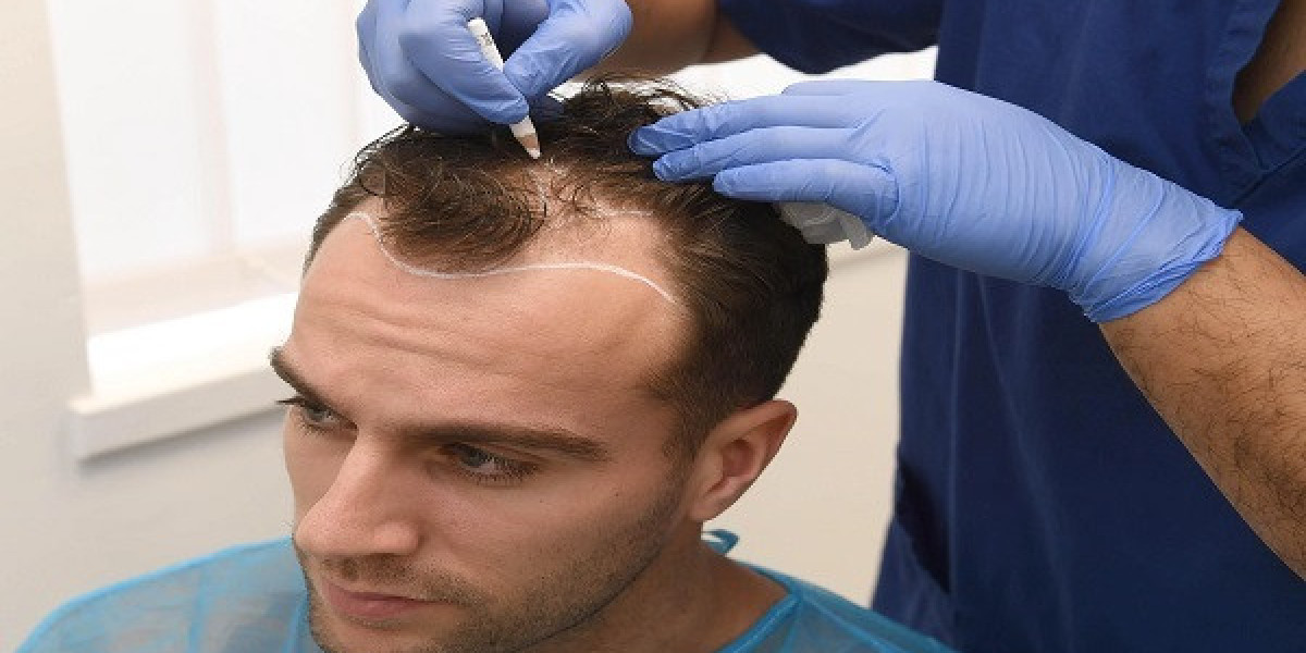 Hair Transplant for Genetic Hair Loss in Islamabad