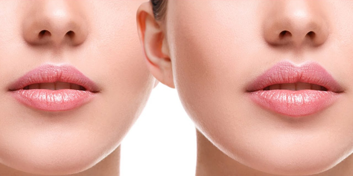 The Best Clinic for Lip Fillers in Islamabad: What to Expect