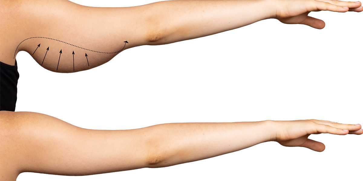 Comparing the Cost of Arm Lift Surgery in Islamabad vs. Lahore