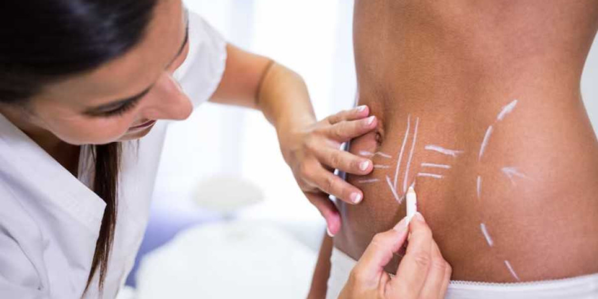 Pre-Surgery Consultation for Liposuction in Islamabad