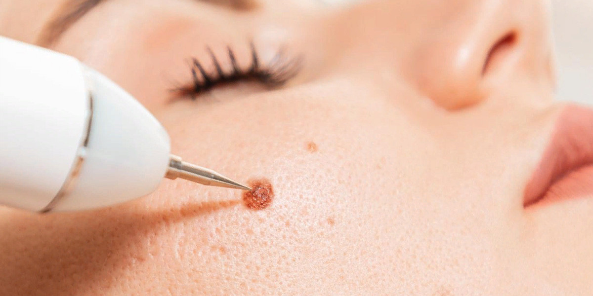 Facts You Didn't Know About Wart Treatment in Islamabad