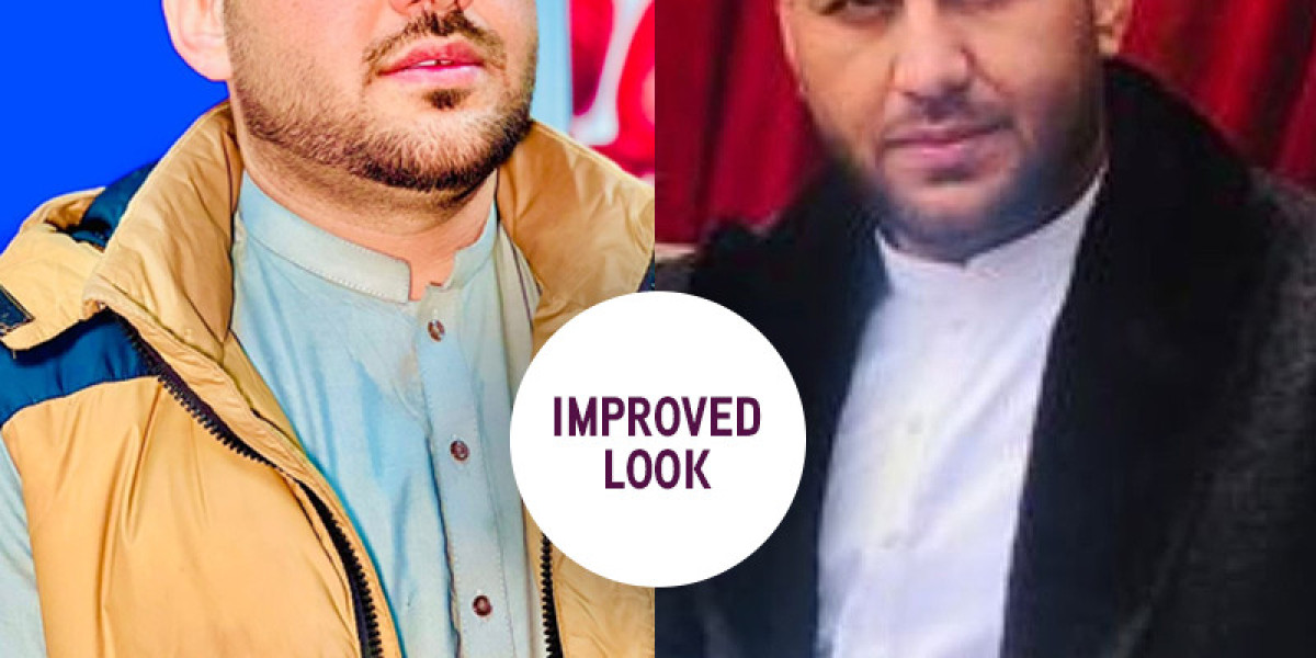 Hair Restoration Surgery A Solution for Hair Loss
