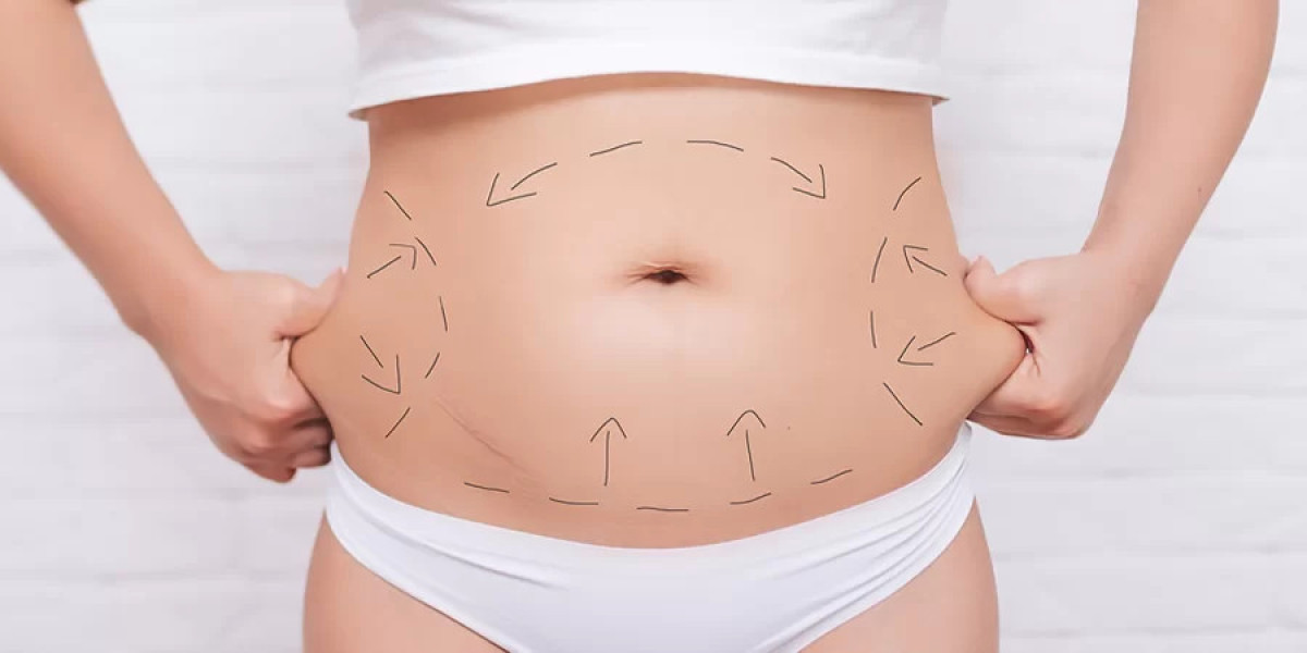 Common Misconceptions Addressed in Tummy Tuck Consultations