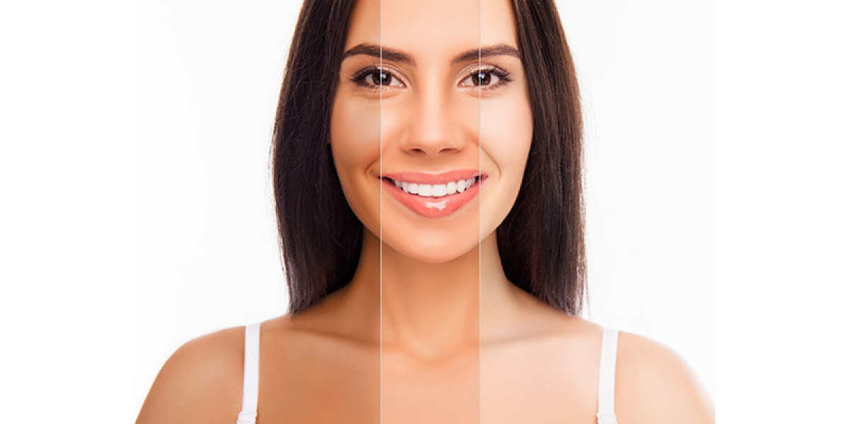 Comparing Whitening Package Prices Across Islamabad Clinics