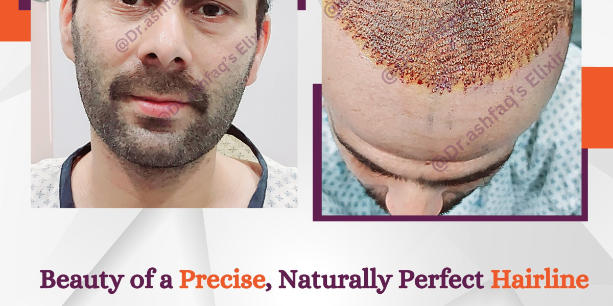 Crown Hair Restoration That Works