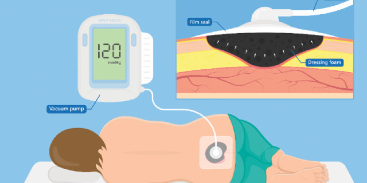 Key Players Drive Negative Pressure Wound Therapy Market Growth: Outlook to 2035