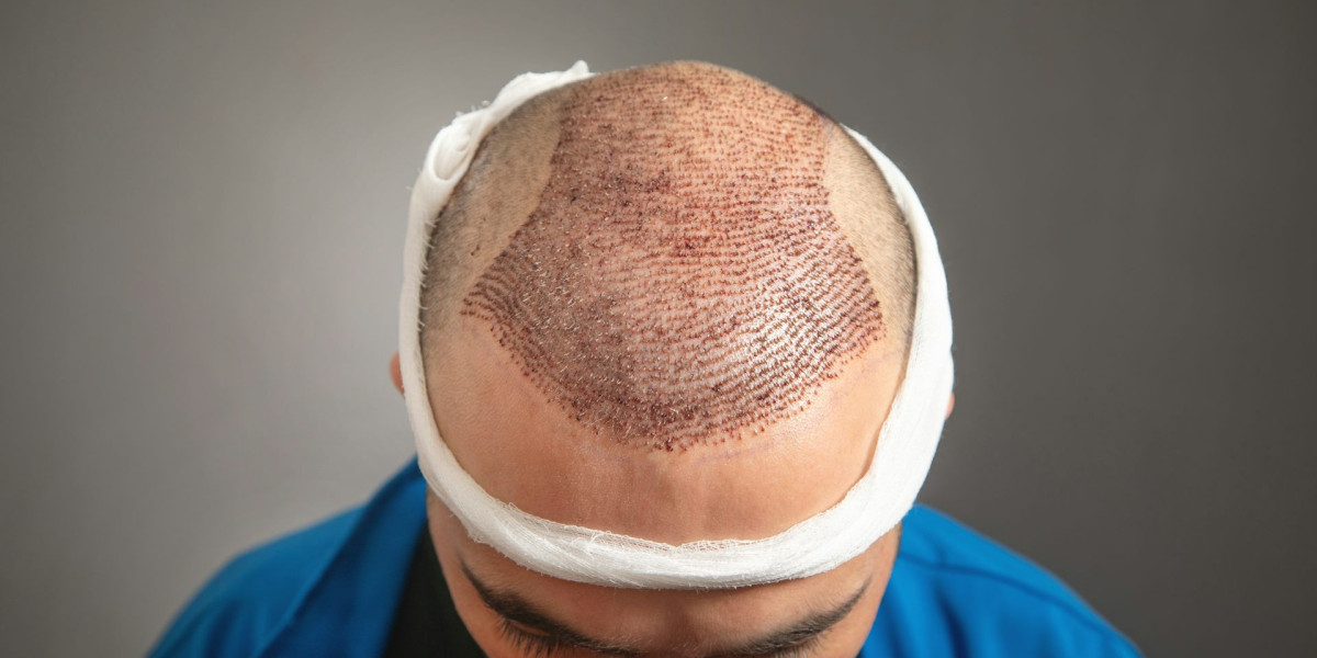 Is a Hair Transplant Worth the Investment?