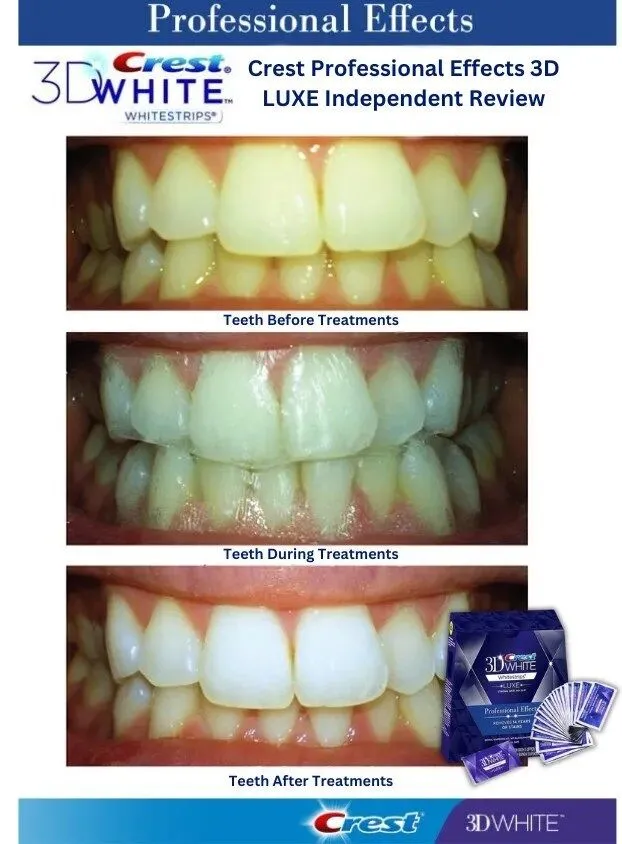 Whitening with Crest 3D Whitestrips: When Will You See Results?