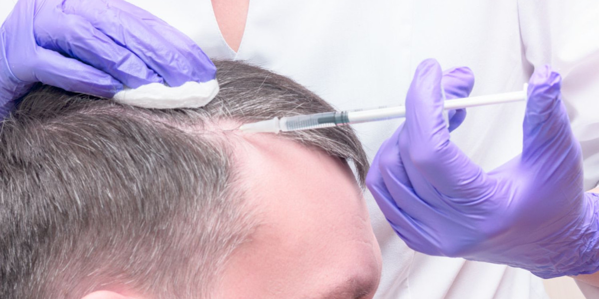 How PRP Therapy is Revolutionizing Hair Loss Treatment?