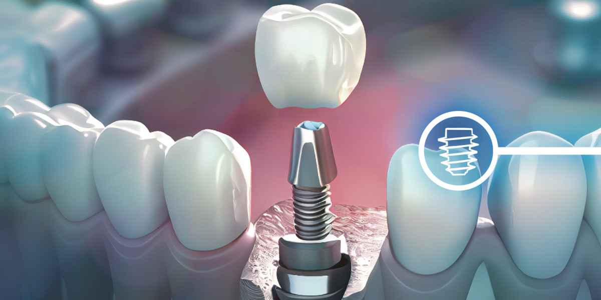Step-by-Step Process of Getting Dental Implants in Islamabad