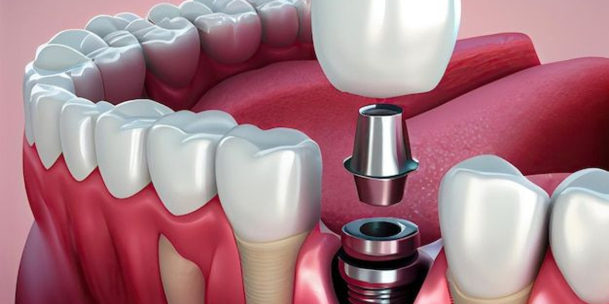 Everything You Need to Know About Dental Implants in Sacramento