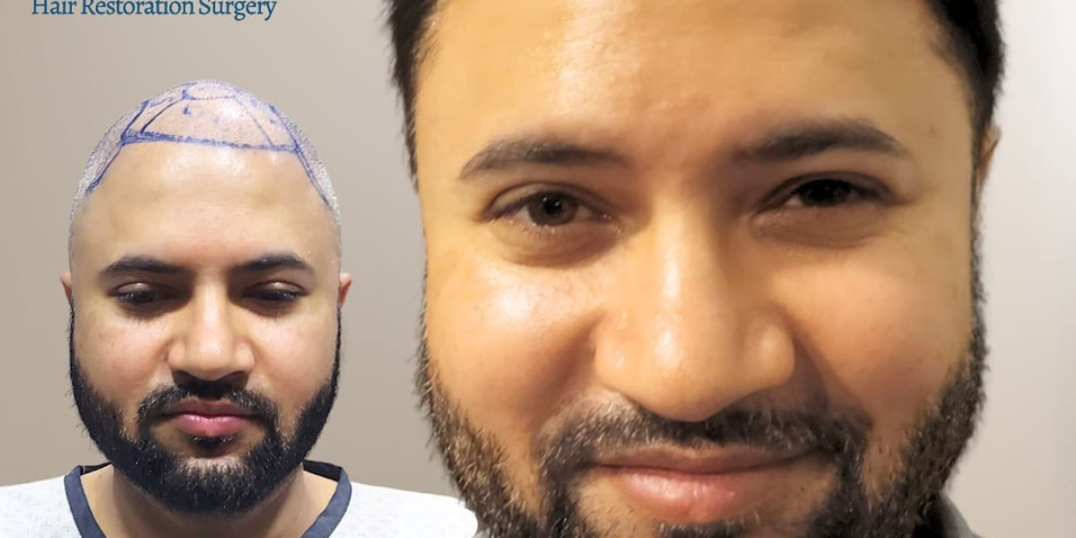 Hair Transplantation for Men in Islamabad