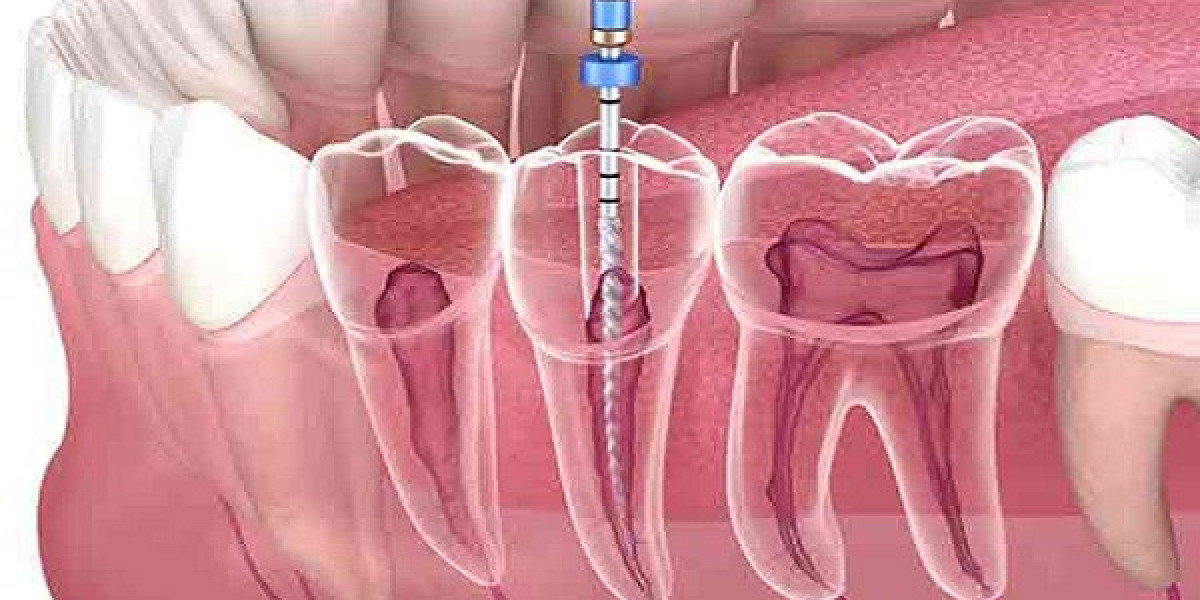 Root Canal Aftercare Checklist for Patients in Islamabad