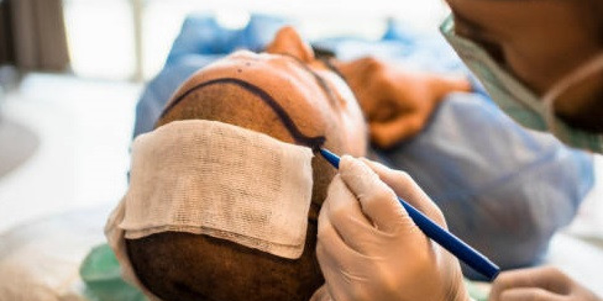 What is the recovery time for a hair transplant?