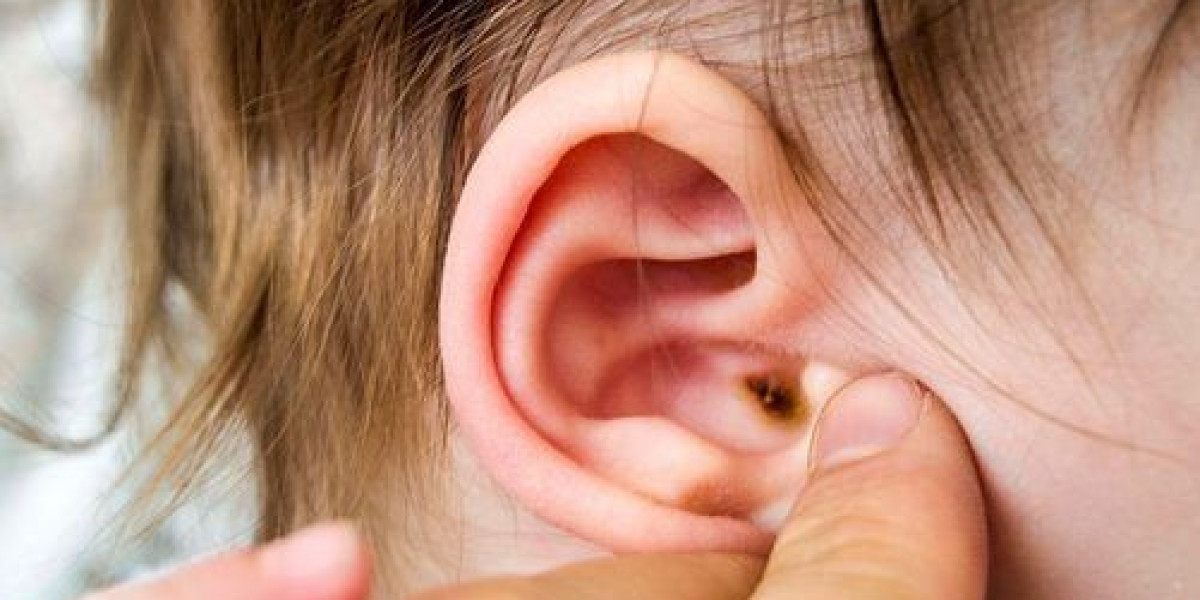 Ear Reshaping Surgery: What You Need to Know