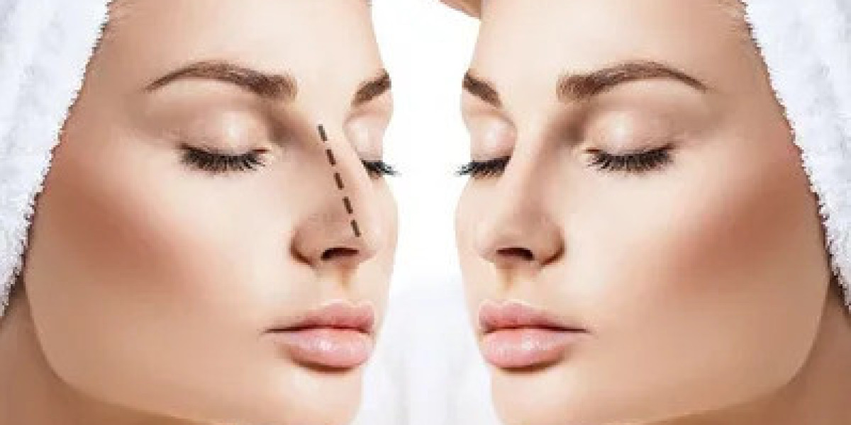 Rhinoplasty for Men: Trending Nose Surgery Facts
