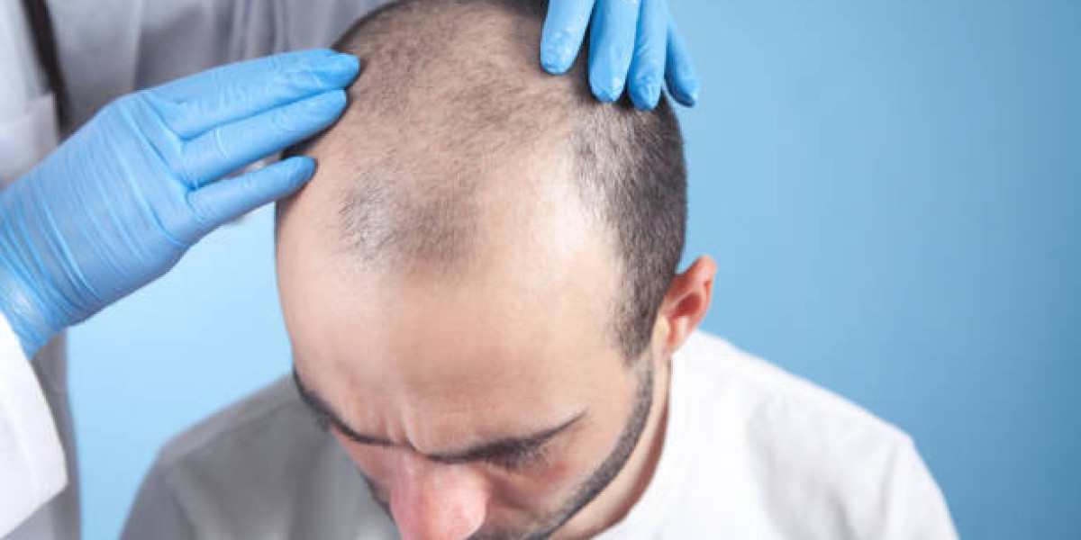 دليلك لاختيار تقنية زراعة الشعر المناسبة بالرياض