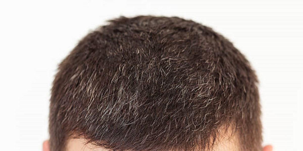 أسرار نجاح زراعة الشعر بالرياض