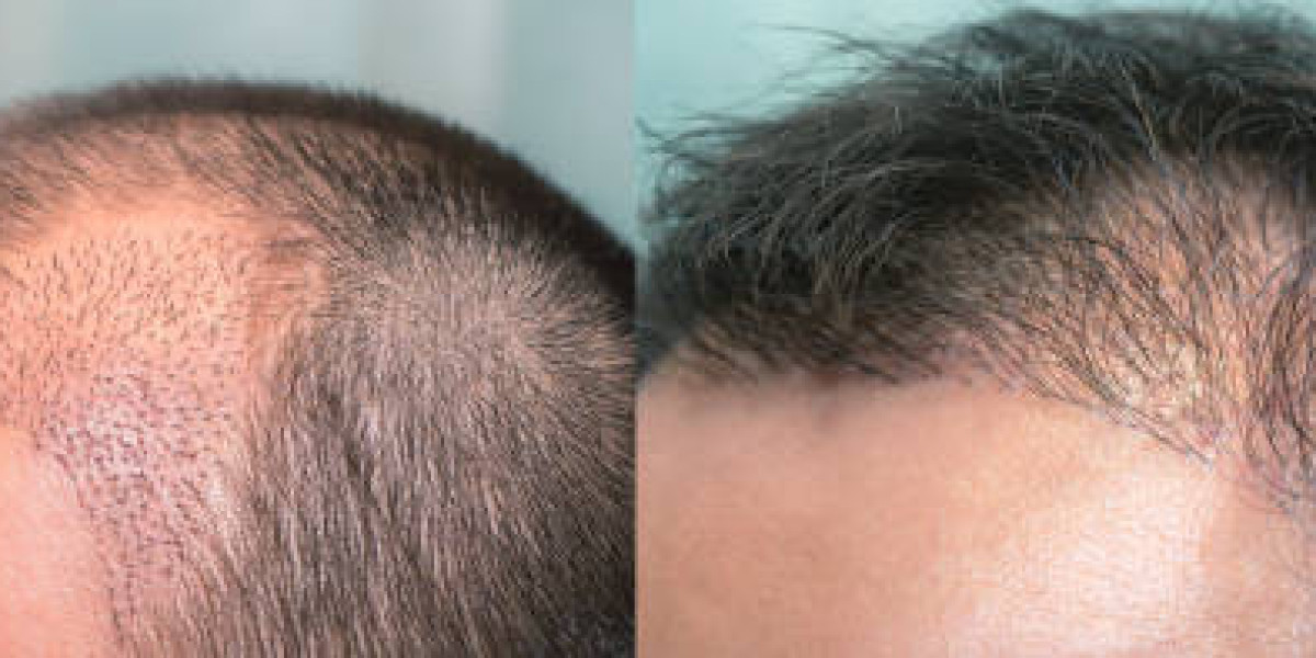 نتائج زراعة الشعر في الرياض: قبل وبعد