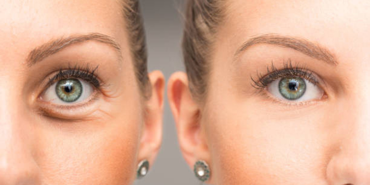 Eyelid Surgery in Riyadh: Procedure Explained
