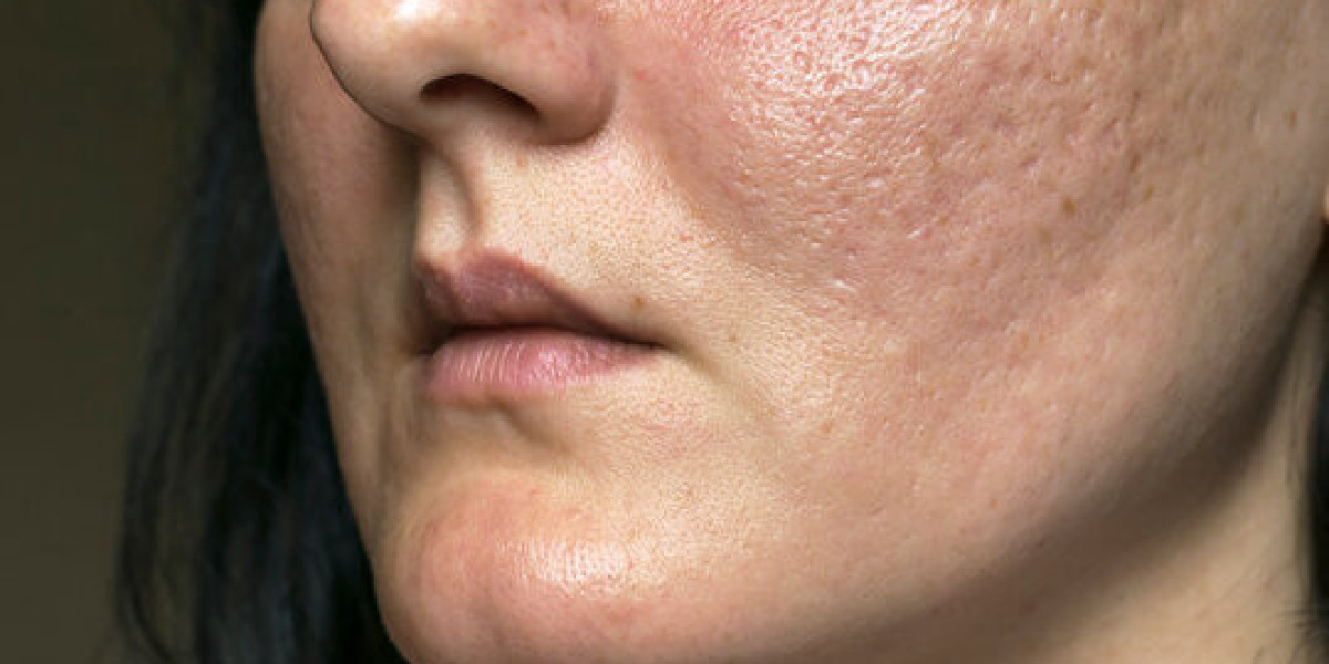 Acne Scar Treatment as Part of Your Self-Care Routine in Islamabad