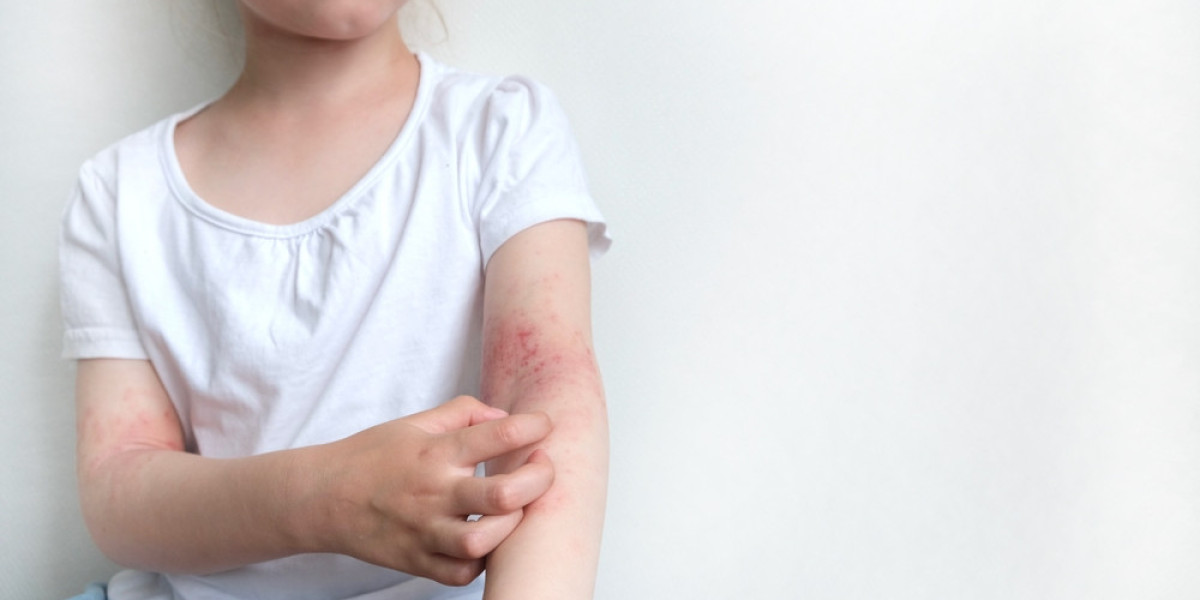 Comparing Childhood and Adult Eczema on Elbows