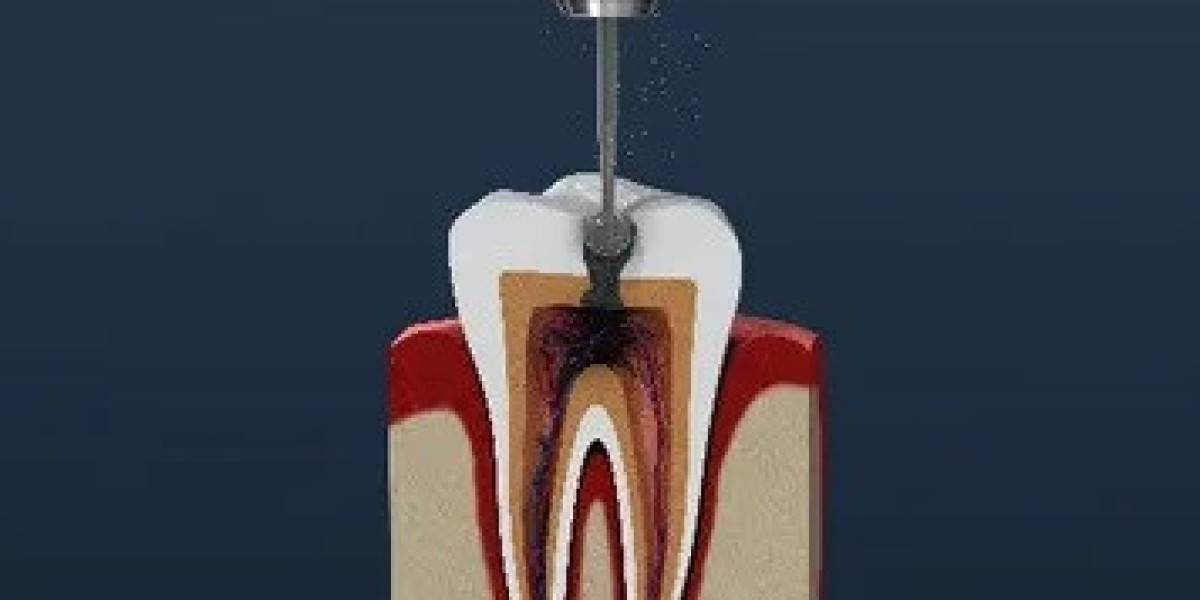 Step-by-Step Root Canal Treatment in Islamabad