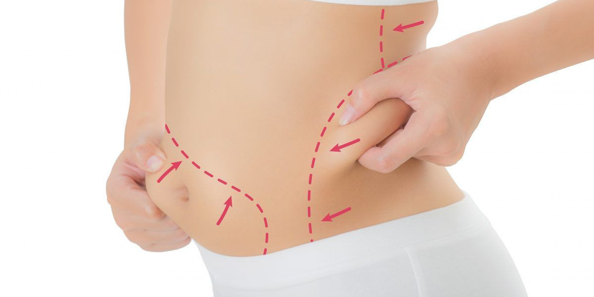 Riyadh Laser Liposuction Success Stories