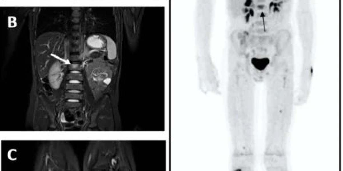 Ewing Sarcoma Treatment Market: Size, Trends, and Strategic Outlook