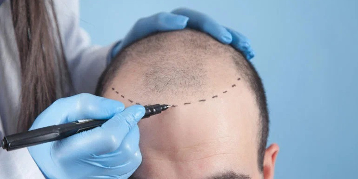 Hair Transplant in Islamabad for Different Age Groups