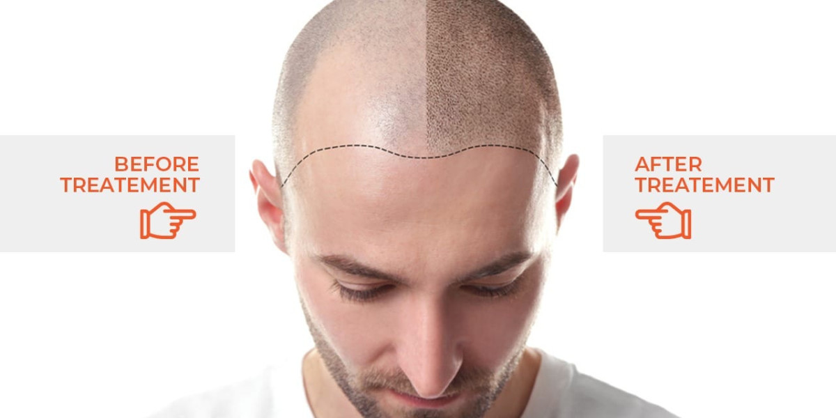 Regain Confidence with Crown Hair Transplants