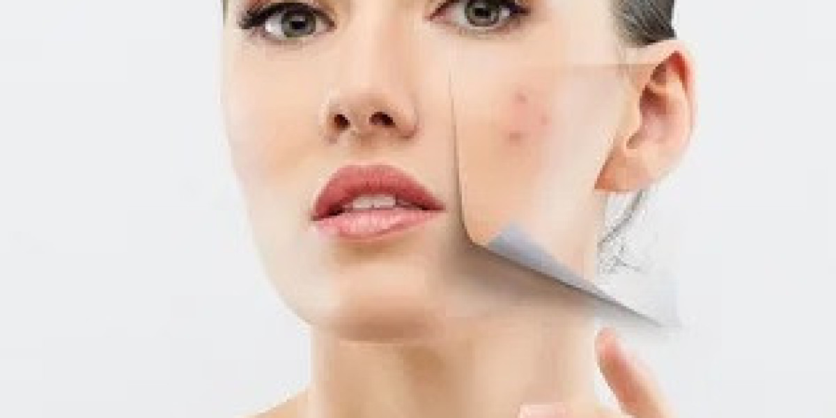 Acne Scar Treatment in Islamabad: FAQs Answered