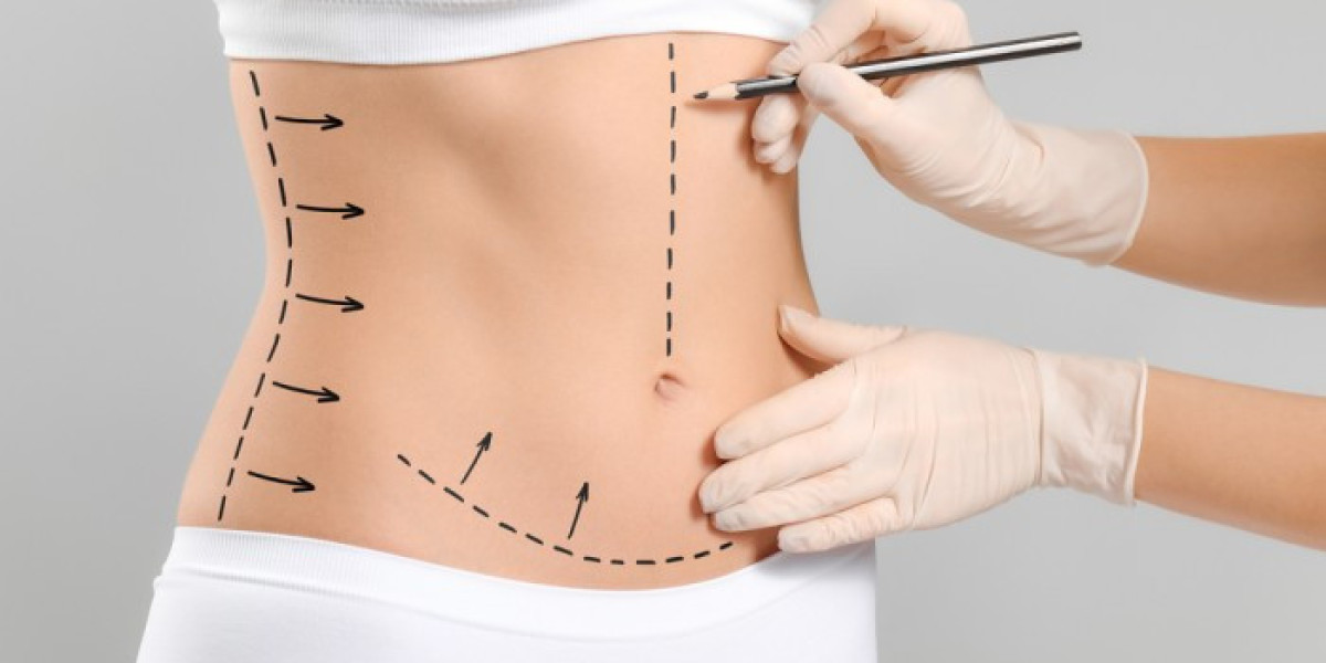 BMI and Liposuction: What You Should Know in Islamabad