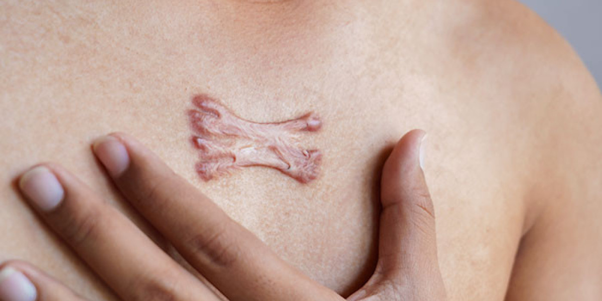 Male Grooming and Keloids: A Guide to Beard Scars and Treatment in Islamabad