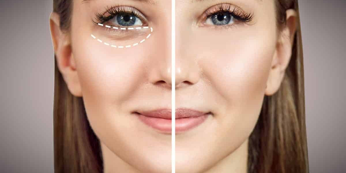 What to Expect After Eye Bag Surgery